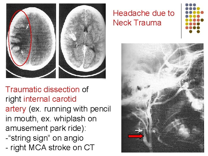 Headache due to Neck Traumatic dissection of right internal carotid artery (ex. running with