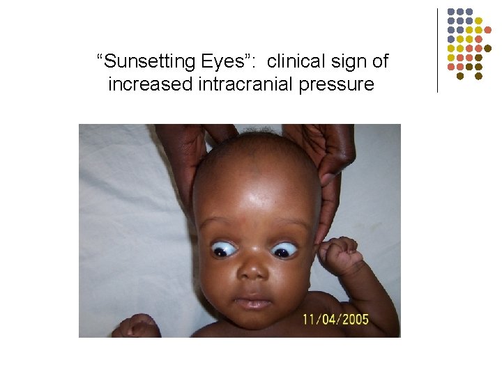 “Sunsetting Eyes”: clinical sign of increased intracranial pressure 