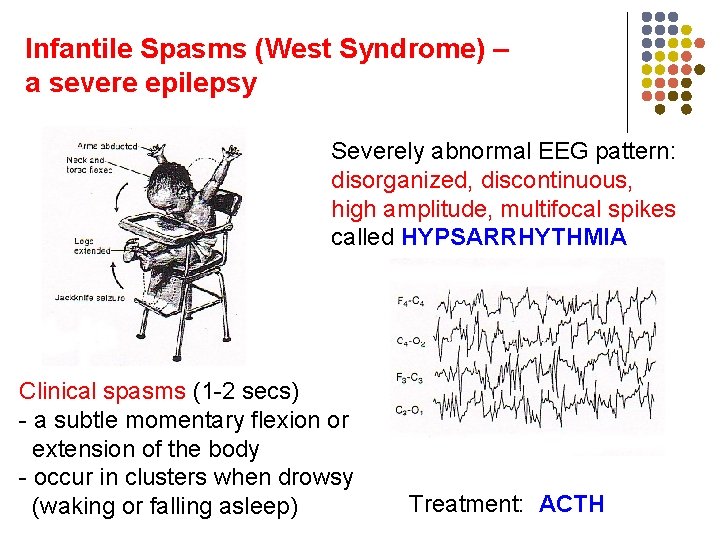 Infantile Spasms (West Syndrome) – a severe epilepsy Severely abnormal EEG pattern: disorganized, discontinuous,