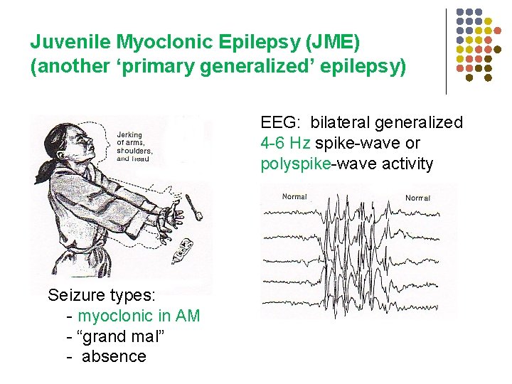 Juvenile Myoclonic Epilepsy (JME) (another ‘primary generalized’ epilepsy) EEG: bilateral generalized 4 -6 Hz