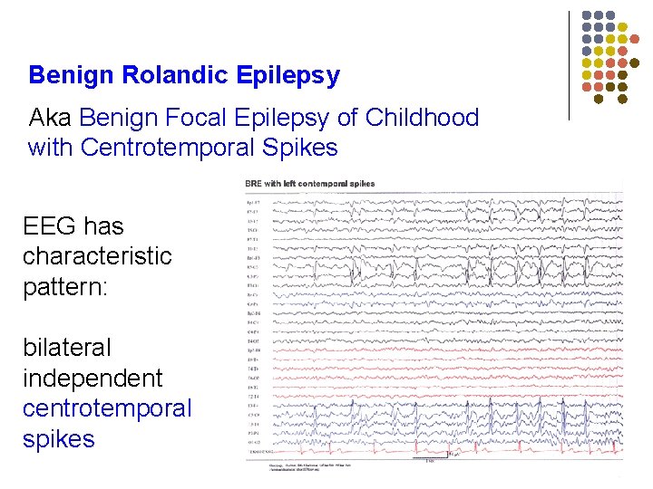 Benign Rolandic Epilepsy Aka Benign Focal Epilepsy of Childhood with Centrotemporal Spikes EEG has