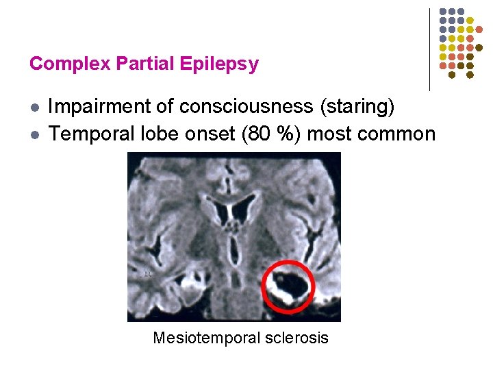 Complex Partial Epilepsy l l Impairment of consciousness (staring) Temporal lobe onset (80 %)
