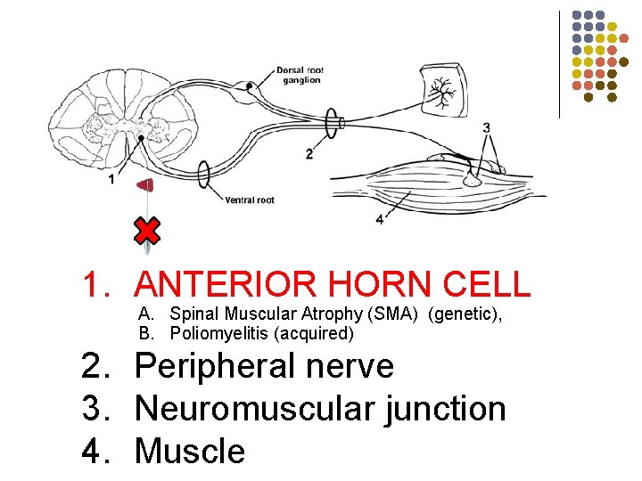 skin 1. ANTERIOR HORN CELL A. Spinal Muscular Atrophy (SMA) (genetic), B. Poliomyelitis (acquired)
