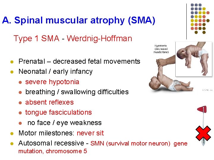 A. Spinal muscular atrophy (SMA) Type 1 SMA - Werdnig-Hoffman l l Prenatal –