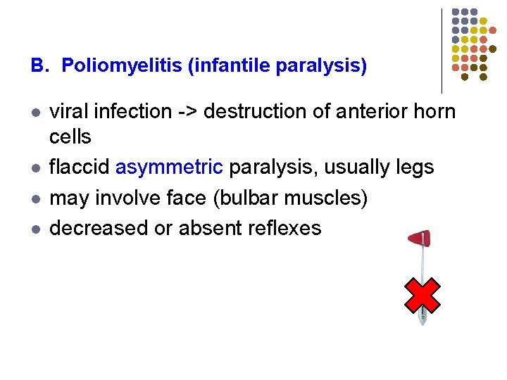 B. Poliomyelitis (infantile paralysis) l l viral infection -> destruction of anterior horn cells