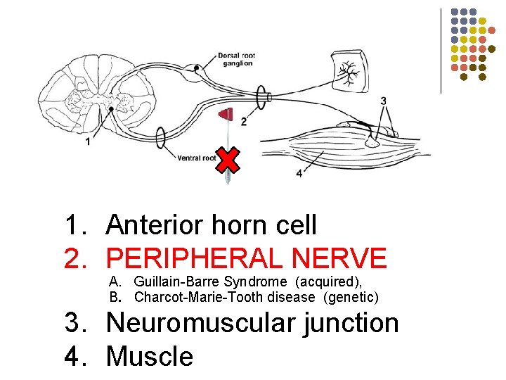 skin 1. Anterior horn cell 2. PERIPHERAL NERVE A. Guillain-Barre Syndrome (acquired), B. Charcot-Marie-Tooth