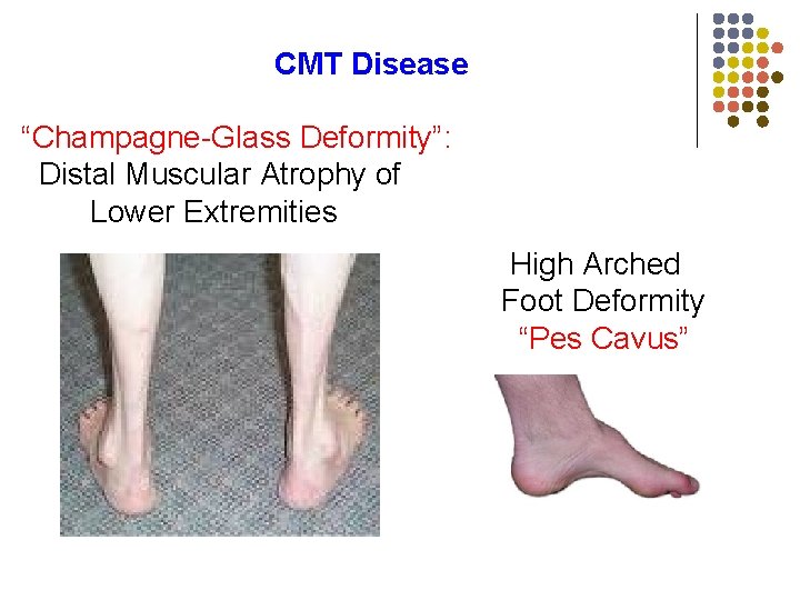 CMT Disease “Champagne-Glass Deformity”: Distal Muscular Atrophy of Lower Extremities High Arched Foot Deformity