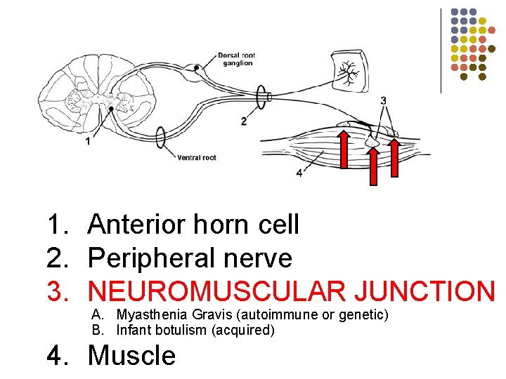 skin 1. Anterior horn cell 2. Peripheral nerve 3. NEUROMUSCULAR JUNCTION A. Myasthenia Gravis