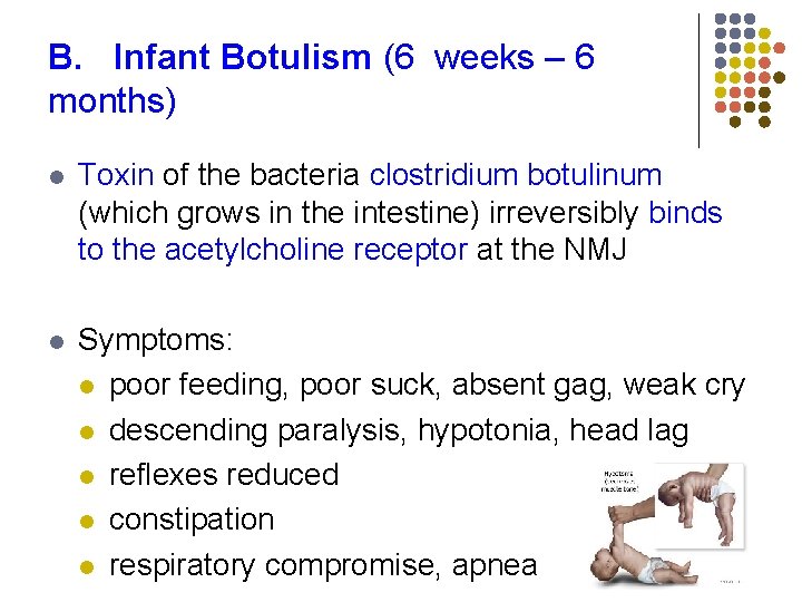 B. Infant Botulism (6 weeks – 6 months) l Toxin of the bacteria clostridium