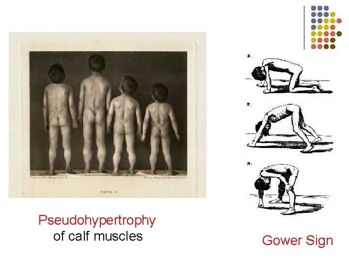 Pseudohypertrophy of calf muscles Gower Sign 