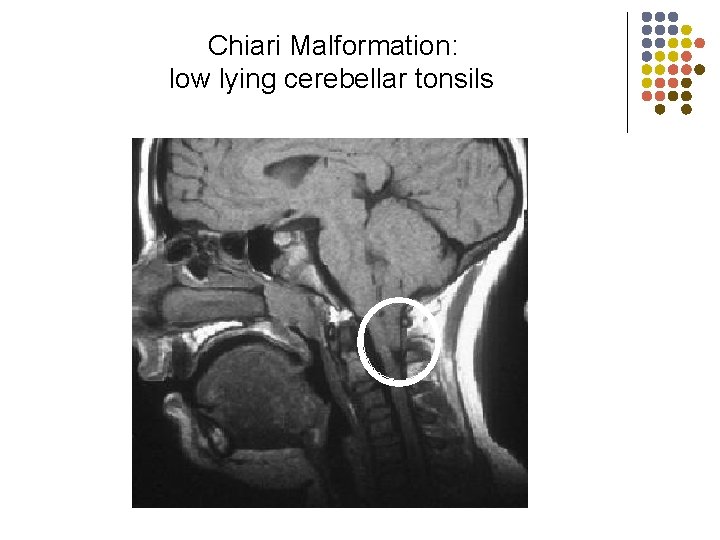 Chiari Malformation: low lying cerebellar tonsils 