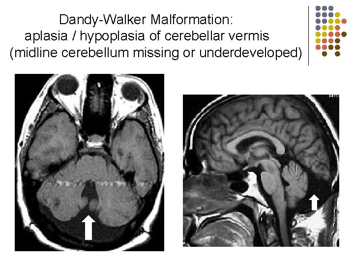 Dandy-Walker Malformation: aplasia / hypoplasia of cerebellar vermis (midline cerebellum missing or underdeveloped) 