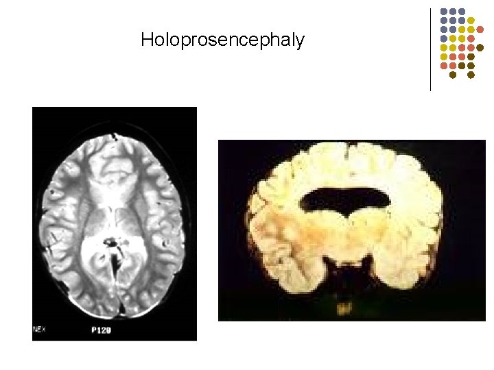 Holoprosencephaly 