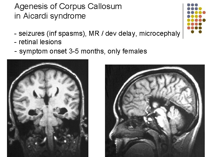 Agenesis of Corpus Callosum in Aicardi syndrome - seizures (inf spasms), MR / dev