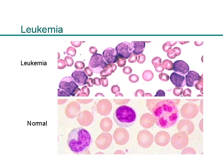Leukemia Normal 