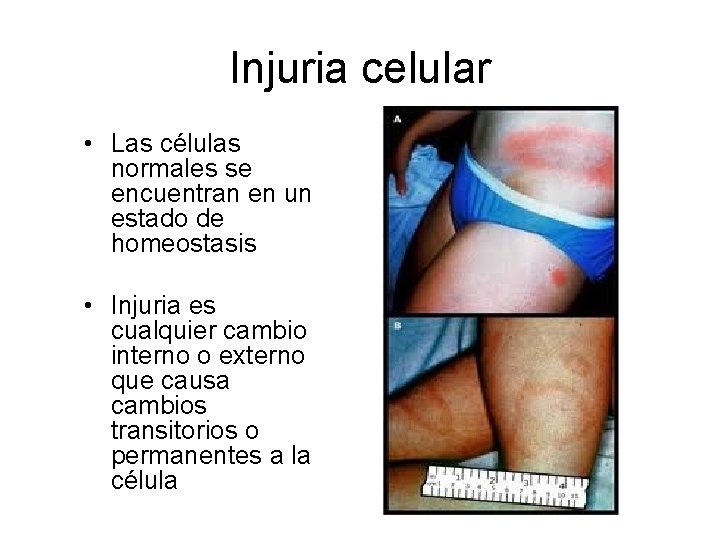 Injuria celular • Las células normales se encuentran en un estado de homeostasis •