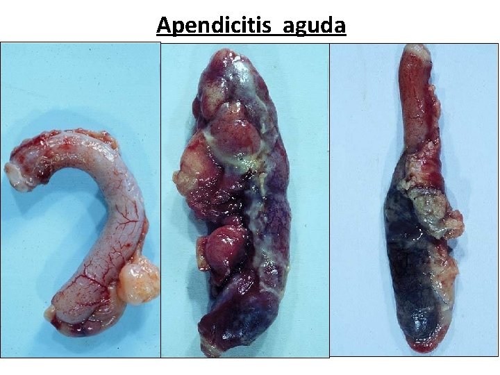 Apendicitis aguda Cátedra de Anatomía Patológica. Facultad de Medicina. U. N. T. 