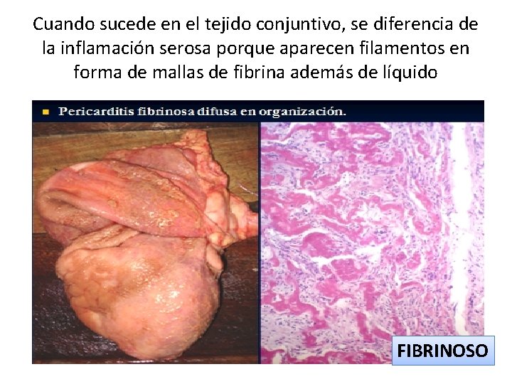 Cuando sucede en el tejido conjuntivo, se diferencia de la inflamación serosa porque aparecen