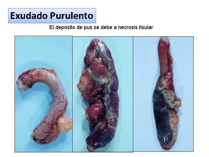 Exudado Purulento El depósito de pus se debe a necrosis tisular Cátedra de Anatomía