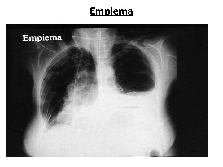 Empiema Cátedra de Anatomía Patológica. Facultad de Medicina. U. N. T. 