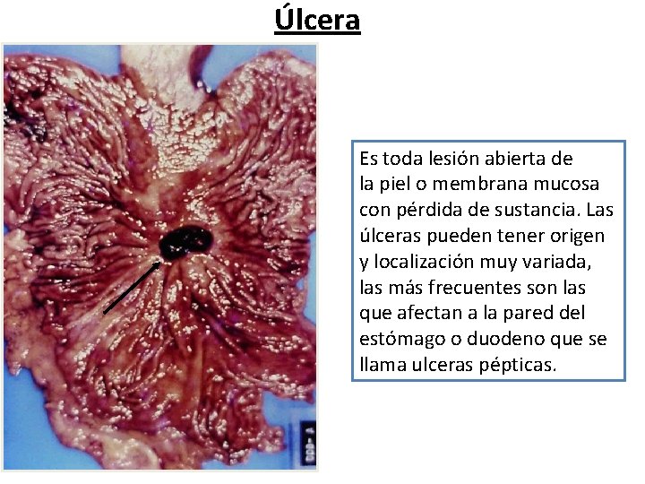 Úlcera Es toda lesión abierta de la piel o membrana mucosa con pérdida de