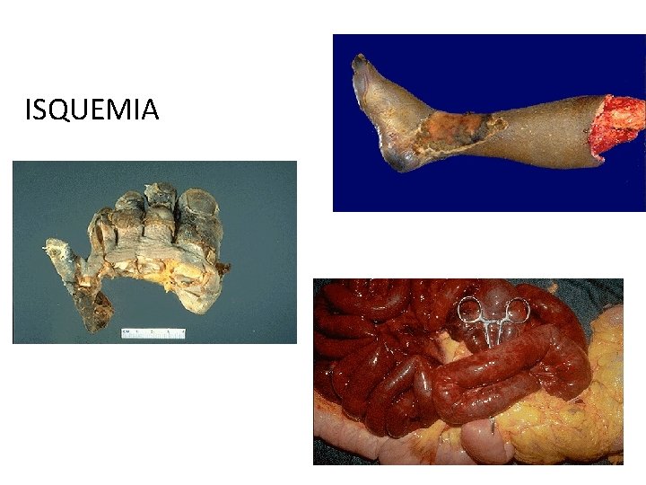 ISQUEMIA 