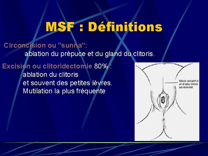 MSF : Définitions Circoncision ou "sunna": ablation du prépuce et du gland du clitoris.