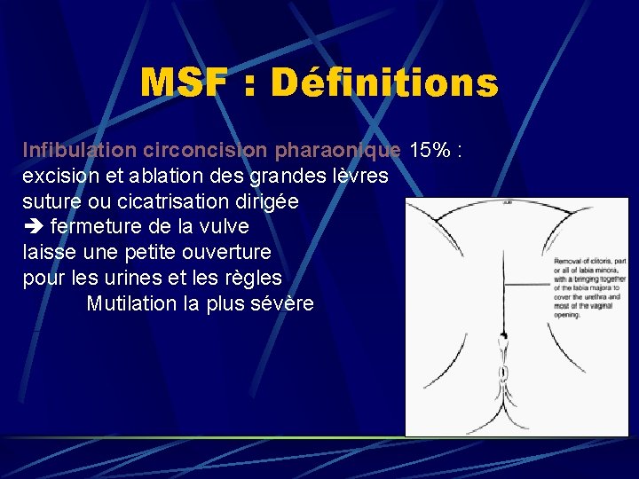 MSF : Définitions Infibulation circoncision pharaonique 15% : excision et ablation des grandes lèvres