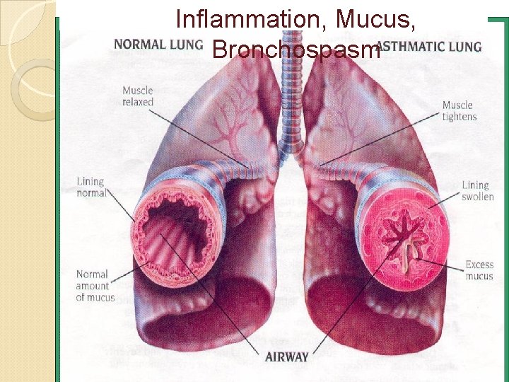 Inflammation, Mucus, Bronchospasm 