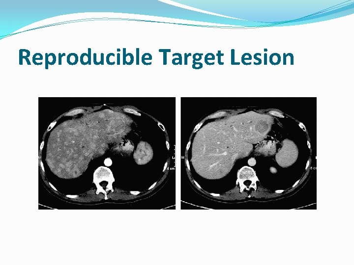 Reproducible Target Lesion 