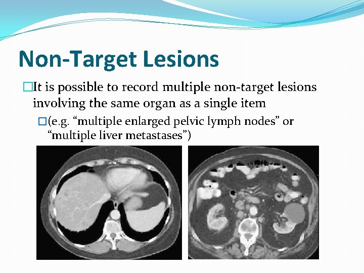 Non-Target Lesions �It is possible to record multiple non-target lesions involving the same organ