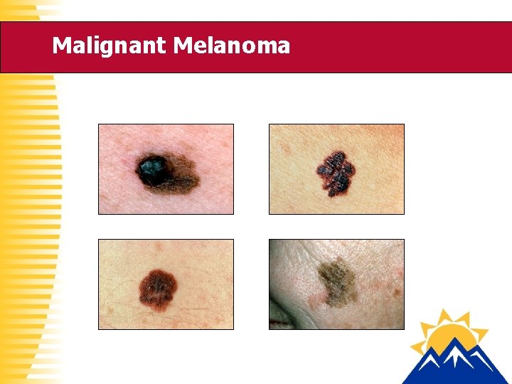 Malignant Melanoma 