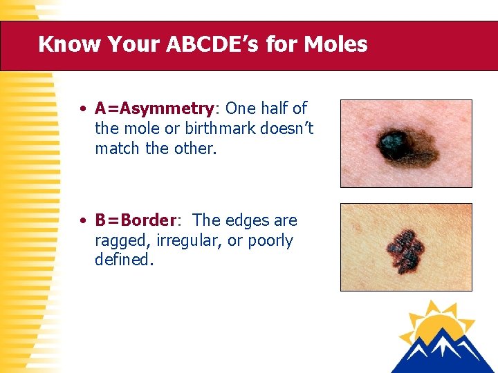 Know Your ABCDE’s for Moles • A=Asymmetry: One half of the mole or birthmark
