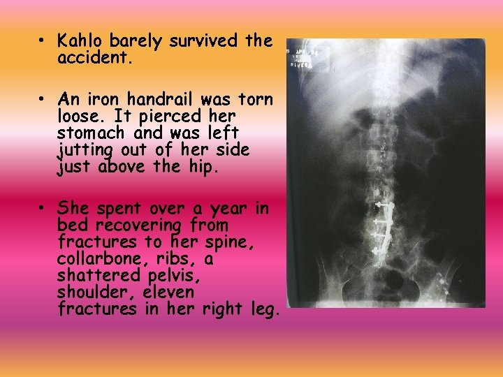  • Kahlo barely survived the accident. • An iron handrail was torn loose.