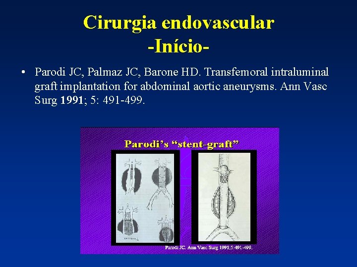 Cirurgia endovascular -Início • Parodi JC, Palmaz JC, Barone HD. Transfemoral intraluminal graft implantation