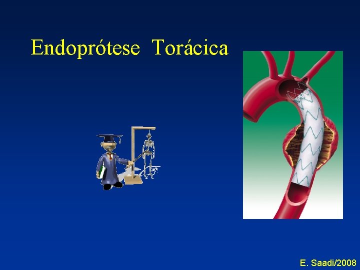 Endoprótese Torácica E. Saadi/2008 