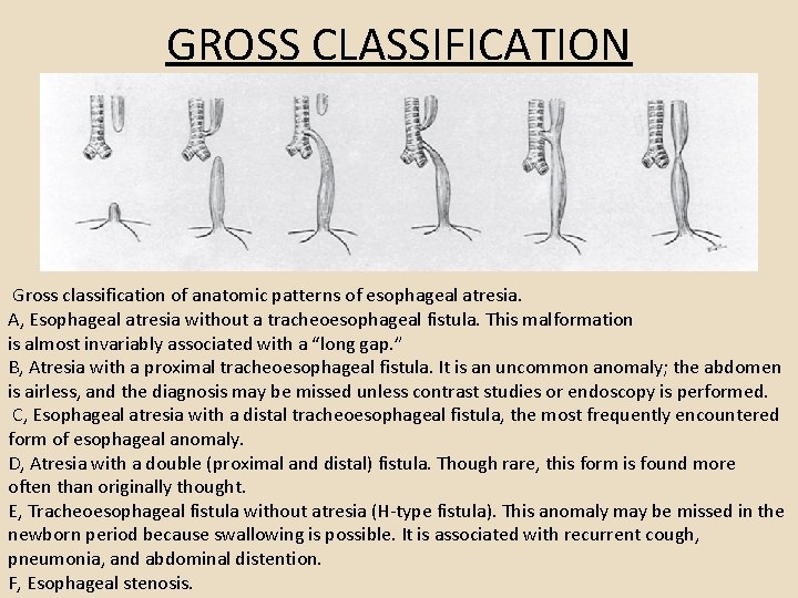 GROSS CLASSIFICATION Gross classification of anatomic patterns of esophageal atresia. A, Esophageal atresia without