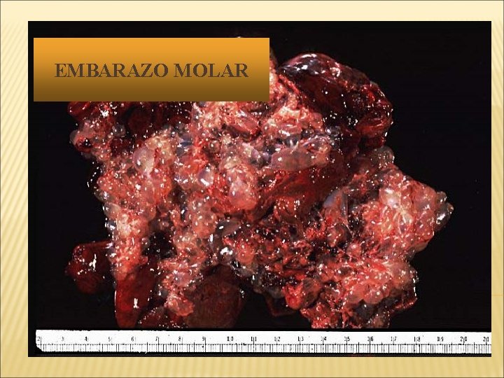 EMBARAZO MOLAR 