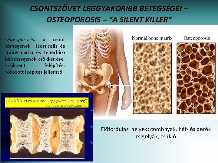 CSONTSZÖVET LEGGYAKORIBB BETEGSÉGEI – OSTEOPOROSIS – “A SILENT KILLER” Osteoporosis: a csont tömegének (corticalis