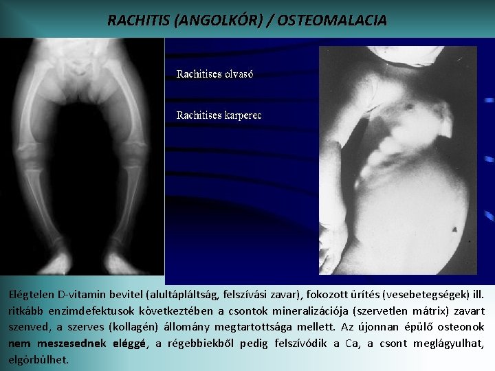 RACHITIS (ANGOLKÓR) / OSTEOMALACIA Elégtelen D-vitamin bevitel (alultápláltság, felszívási zavar), fokozott ürítés (vesebetegségek) ill.