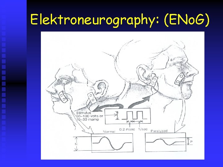 Elektroneurography: (ENo. G) 
