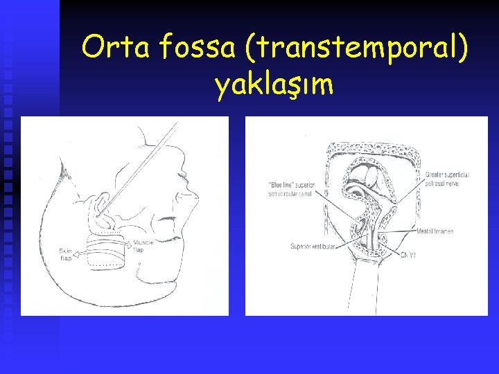 Orta fossa (transtemporal) yaklaşım 