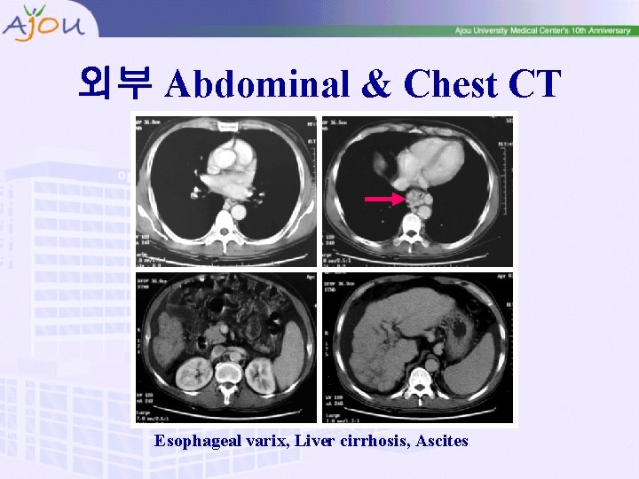 외부 Abdominal & Chest CT Esophageal varix, Liver cirrhosis, Ascites 