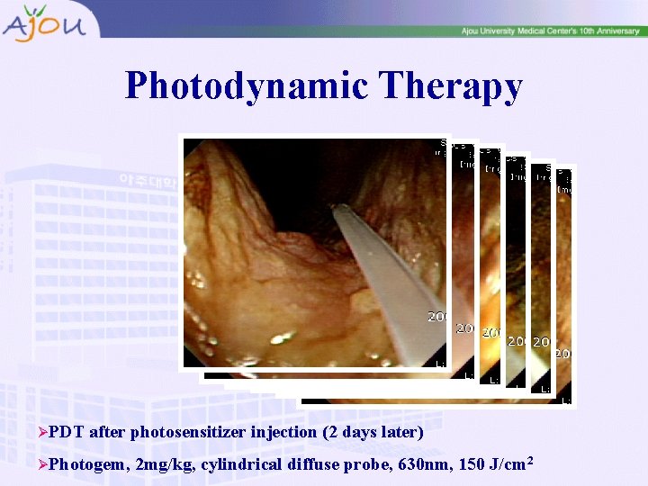 Photodynamic Therapy ØPDT after photosensitizer injection (2 days later) ØPhotogem, 2 mg/kg, cylindrical diffuse