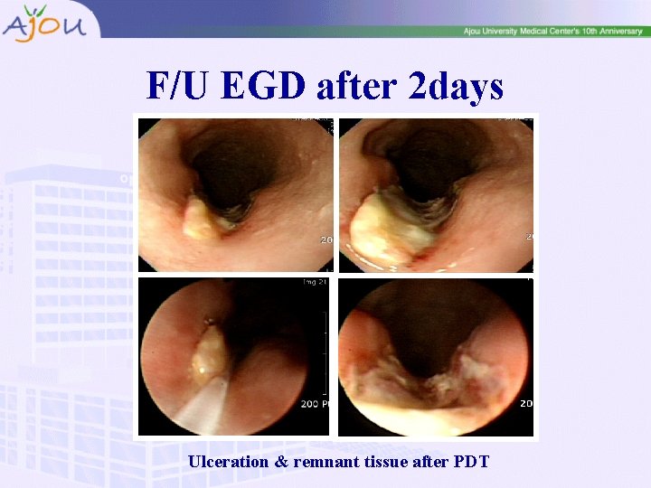 F/U EGD after 2 days Ulceration & remnant tissue after PDT 