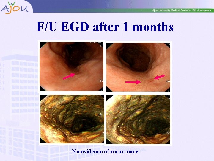 F/U EGD after 1 months No evidence of recurrence 