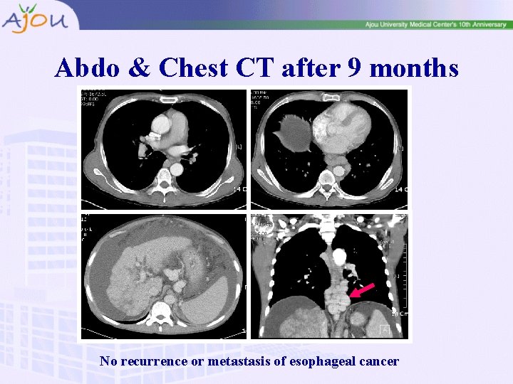 Abdo & Chest CT after 9 months No recurrence or metastasis of esophageal cancer