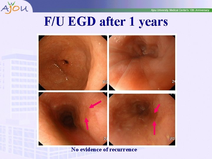 F/U EGD after 1 years No evidence of recurrence 