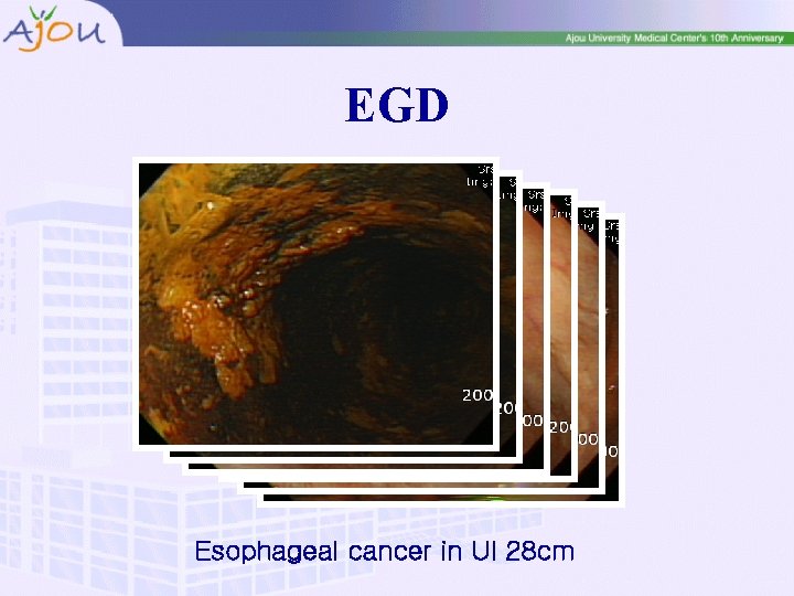 EGD Esophageal cancer in UI 28 cm 