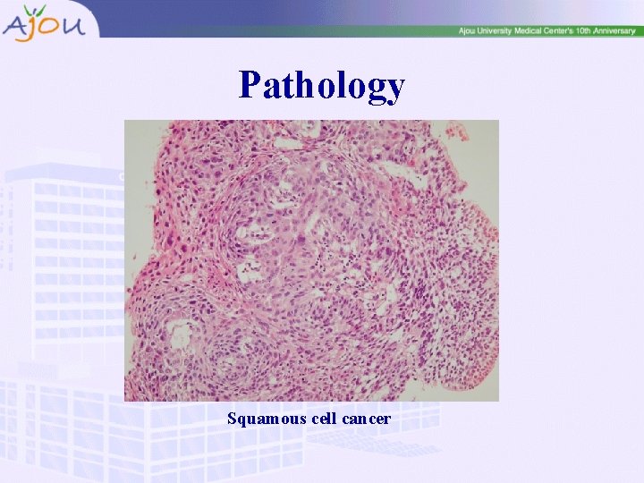 Pathology Squamous cell cancer 